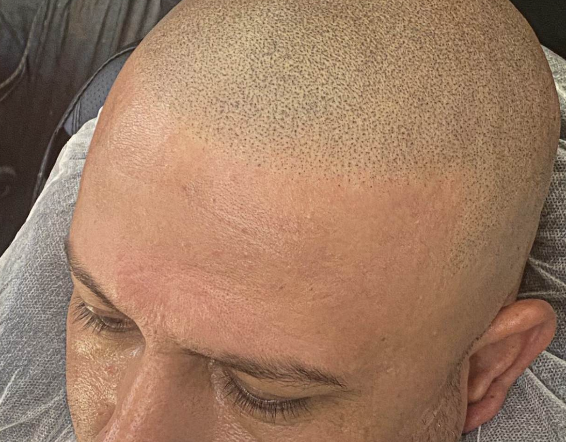 Hatfish Scalp Micropigmentation Los Angeles Ca